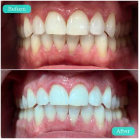 Teeth Whitening Results - Buffalo Teeth Whitening Service