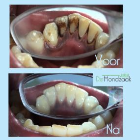 Een extreem voorbeeld van de binnenkant van de tanden, maar dit soort resultaten behalen we met regelmaat! Hoe mooi kan het worden.