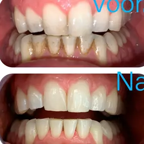Bij de onder voortanden zit meestal wat meer aanslag. Aanslag ontstaat door o.a. koffie, thee en rode wijn. Het ziet er niet fris uit maar aanslag alleen kan geen kwaad. Natuurlijk is het geen visitekaartje. Durf weer voluit te lachen nadat je bij ons bent geweest!
