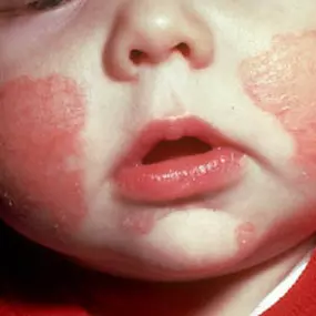 We help treat Eczema