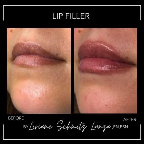 What can lip filler do for you? Lip fillers are a popular cosmetic treatment used to enhance the shape and size of the lips. Check out this before and after photo of lip filler by Modesto Aesthetics and Laser’s Master Injector Liriane Schmitz Lanza, RN, BSN. We are very lucky to have her on our team, as her lip fillers always look fantastic! If you’re ready for fuller and more luscious lips, schedule an appointment with her today!