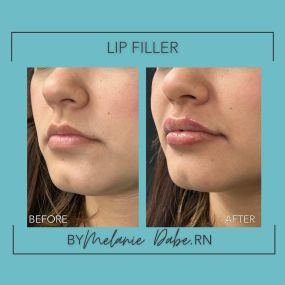 Get the perfect pout at Modesto Aesthetics and Laser, plump up your lips, and unleash your inner sass with luscious lips courtesy of lip filler by Master Injector Melanie Dabe, RN. Let us help you unleash your natural beauty!