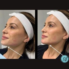 Are you ready to define your jawline like never before? We’re thrilled to announce that Modesto Aesthetics and Laser now offers our latest treatment: the Snatched Jawline Transformation. Say goodbye to pesky jowls and hello to a sculpted, contoured jawline that turns heads. Ready to unleash your confidence? Book your consultation with us today, and let us sculpt the jawline you have always wanted!