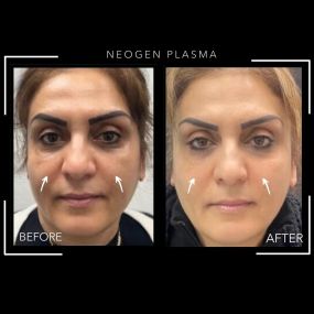 How would you like a non-surgical facelift with NeoGen PSR? Modesto Aesthetics and Laser’s team of medical professionals can dramatically enhance your skin with this innovative procedure. Just one treatment with NeoGen can improve the overall tone and texture of your skin! Contact Modesto Aesthetics and Laser to schedule a free consultation today!