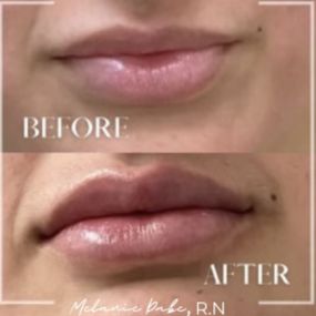 Lip filler can bring balance to the face and boost your confidence. Enhance your natural beauty with a lip augmentation and transform your lips our master injector Melanie Dabe, R.N at Modesto Aesthetics and Laser.