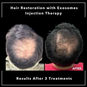 Bring back your confidence! Our 28-year-old patient was struggling with hair loss. Results after three treatments over a four month period Hair Restoration with Exosomes Injections Therapy. Contact Modesto Aesthetics and Laser for a consultation.