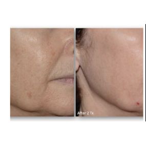 LaseMD Ultra from Modesto Aesthetics is a laser procedure that does not require a significant amount of downtime since the laser heats the deep layers of your skin without damaging the surface of your skin.