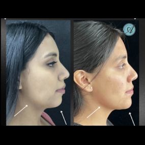 Our expert injector at Modesto Aesthetics and Laser, Liriane Schmitz Lanza, RN, BSN, used multiple syringe of face filler to balance this patients chin and jawline. Give us a call for more information about this service.