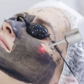 Many people are opting for The Hollywood Laser Peel at Modesto Aesthetics, also known as a Hollywood Carbon Laser Peel. A facial treatment combining the benefits of carbon and Q-Switch laser technology. Our patients are consistently amazed by the improvement they notice from their very first session.