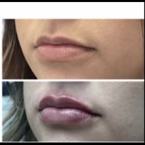 A Modesto Aesthetics and Laser fan favorite is our lip filler procedure we call “Lip Pop”. Add volume to plump lips, smooth lines, or lift & contour cheeks—we have what you need to get the results you want.