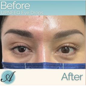 Lift your eyelids quickly at Modesto Aesthetics and Laser in Modesto, CA. Most patients in clinical trials had a lift in their eyelids in as little as two hours! 84% of patients had some degree of improvement, and 74% of patients had more than 50% improvement! Stop by to pick up this incredible new product!