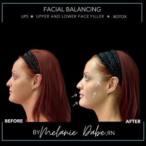 Achieving facial balance with dermal fillers and Botox by Modesto Aesthetics and Laser’s Master Injector Melanie Dabe, RN. Enhance your profile and restore a more youthful glow. Check out our patient’s results and enhanced profile. Contact us today to schedule your appointment with Melanie.