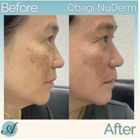 The Obagi Nu-Derm system helps to transform skin by addressing hyper-pigmentation and improving visible signs of skin aging. If you are interested in trying the Obagi Nu-Derm series of products, call or text Modesto Anesthetics and Laser located on 3501 Coffee Road in Modesto, CA to schedule a free consultation or appointment!