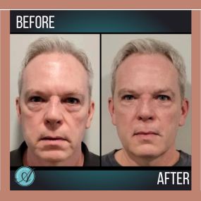 Men love Neogen too!

He received a Neogen Plasma facial treatment and saw his;

✔Face tightened

✔Wrinkles and under-eye bags diminished

✔Tighter, well rested face

He was thrilled with his results!

Call or text to schedule a free consultation! 209.577.3340