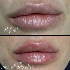 Lip filler provides balance and symmetry on this clients lips! Call or text Modesto Aesthetics and Laser to schedule your appointment!