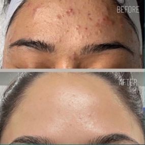 Are you struggling with acne or acne scars? Modesto Aesthetics & Laser has you covered with our Microchanneling treatment!! Learn more today how this procedure stimulates collagen production and leaving behind healthy, renewed, and younger looking skin with tighter and more even skin tone. Modesto Aesthetics and Laser wants to help your skin glow and feel like your best self.