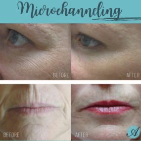 Microchanneling is a cutting-edge biotechnology procedure in which a hand-held device with precision micro tips taps into the skin creating hundreds of thousands of microchannels in the skin, creating injury to the dermal layer of the skin, stimulating collagen production, and leaving behind healthy, renewed, and younger looking skin with tighter and more even skin tone.