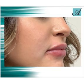 Modesto Aesthetics & Laser can help you get the plump, fullness, and volume in your lips you have always wanted.