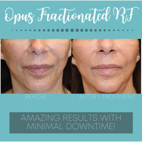 The future of skin resurfacing is one call away with Opus Fractionated RF. Get visible results after one treatment.