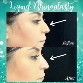 Liquid Rhinoplasty!