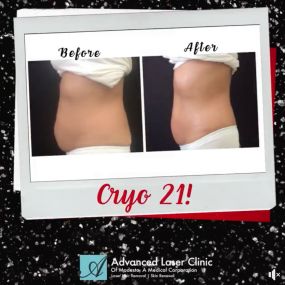 Lose Inches Cyro 21