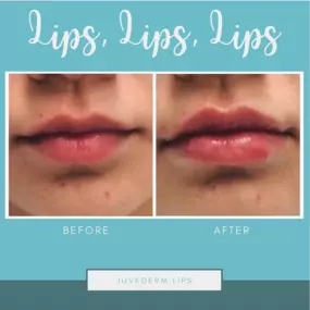 Juvéderm Lips