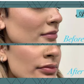 Buy a filler and get some Botox ON US❗

That’s right pick a filler: Juvederm, Volbella, Vollure, or Voluma!