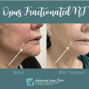 Look at the amazing improvement on this patient's skin laxity after just ONE Opus treatment! These results don't lie! Call or text Modesto Aesthetics & Laser for your complimentary consultation today.