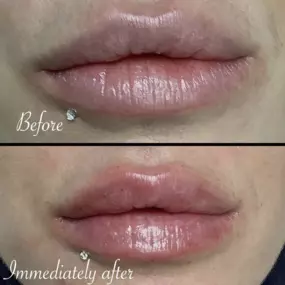 Lip filler provides balance and symmetry on this clients lips! Call or text Modesto Aesthetics and Laser to schedule your appointment!