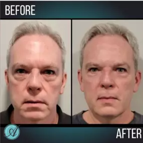 Men love Neogen too!

He received a Neogen Plasma facial treatment and saw his;

✔Face tightened

✔Wrinkles and under-eye bags diminished

✔Tighter, well rested face

He was thrilled with his results!

Call or text to schedule a free consultation! 209.577.3340