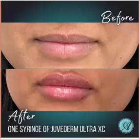 Hello Lovely Lips!

One syringe of Juvéderm XC for this MAL doll gave her the fuller lips and finer shape she's been dreaming of! Master Injector Jonna, RN did an AMAZING job with this beautiful client!

Call or text 209.577.3340 to schedule a free consultation with us today!