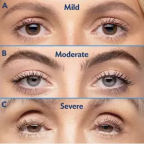 As we age the eye muscles weaken, resulting in droopy eyelids. Talk to Modesto Aesthetics and Laser to find out if you have low-lying lids. Individuals with low-lying lids—whether mild, moderate, or severe—can benefit from treatment!