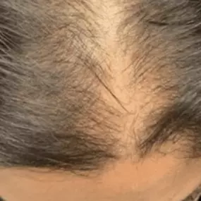 Keralase from Modesto Aesthetics and Laser (https://www.modestoaestheticsandlaser.com/) works by using Lutronic Ultra laser treatment and KeraFactor. KeraFactor is a serum with proprietary biometric synthetic versions of proteins, growth factors, and proteins that promote hair growth.