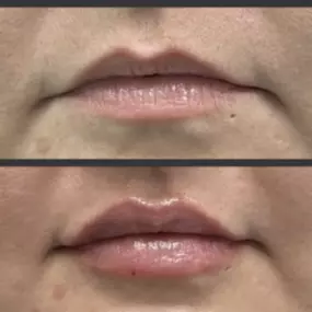 Fuller, rounder, and a perfect pout is what you'll receive when choosing Modesto Aesthetics and Laser for your next syringe of Juvederm XC lip fillers.