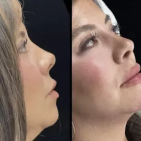 Looking for a place in Modesto to receive dermal fillers? Modesto Aesthetics & Laser provides dermal fillers from the Juvederm Family of Fillers. Juvederm offers 5 different products to meet your specific needs in adding volume to plump lips, smooth lines, or lift and contour cheeks.