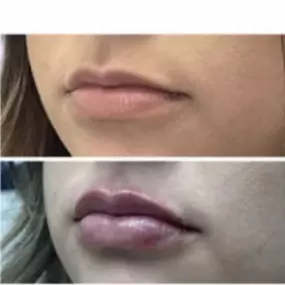 A Modesto Aesthetics and Laser fan favorite is our lip filler procedure we call “Lip Pop”. Add volume to plump lips, smooth lines, or lift & contour cheeks—we have what you need to get the results you want.