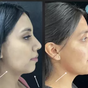 Our expert injector at Modesto Aesthetics and Laser, Liriane Schmitz Lanza, RN, BSN, used multiple syringe of face filler to balance this patients chin and jawline. Give us a call for more information about this service.