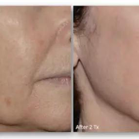 LaseMD Ultra from Modesto Aesthetics is a laser procedure that does not require a significant amount of downtime since the laser heats the deep layers of your skin without damaging the surface of your skin.