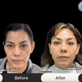 NeoGen at Modesto Aesthetics and Laser is a regenerative skin treatment that delivers dramatically different results and is an FDA Approved skin resurfacing procedure for the face, neck, and chest.