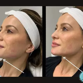 Are you ready to define your jawline like never before? We’re thrilled to announce that Modesto Aesthetics and Laser now offers our latest treatment: the Snatched Jawline Transformation. Say goodbye to pesky jowls and hello to a sculpted, contoured jawline that turns heads. Ready to unleash your confidence? Book your consultation with us today, and let us sculpt the jawline you have always wanted!