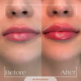 At Modesto Aesthetics and Laser, our Master Injector Liriane Schmitz Lanza, BSN, RN is transforming smiles one lip at a time. If you’re looking for a professional and high-quality lip injection procedure, look no further, contact Modesto Aesthetics and Laser today.