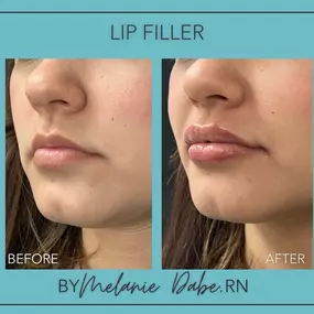 Get the perfect pout at Modesto Aesthetics and Laser, plump up your lips, and unleash your inner sass with luscious lips courtesy of lip filler by Master Injector Melanie Dabe, RN. Let us help you unleash your natural beauty!