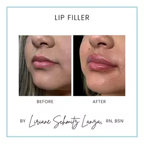 Another set of gorgeous lips by Master Aesthetic Injector Liriane Schmitz Lanza RN, BSN of Modesto Aesthetics and Laser. Discover the benefits of hydrated lips with hyaluronic acid lip fillers like the Juvederm Family and the RHA Line of fillers. Get the gorgeous smile you want today with fuller, youthful lips. Schedule an appointment today!