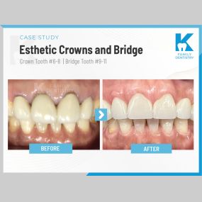 K Family Dentistry | Esthetic Crowns and Bridge Case Study