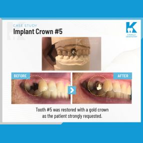 Case Study | Implant Crown #5 | K Family Dentistry