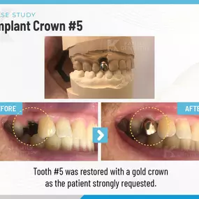 Case Study | Implant Crown #5 | K Family Dentistry