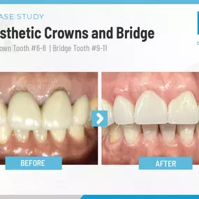 K Family Dentistry | Esthetic Crowns and Bridge Case Study