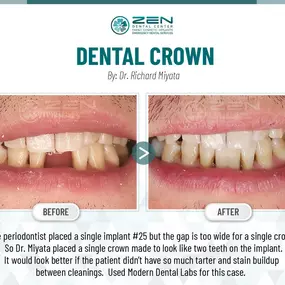 Zen Dental Center Family, Cosmetic, Implants -  Call: 206-324-1100 | Location: 310 Harvard Ave, Unit E Seattle, Washington 98102