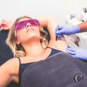 laser hair removal